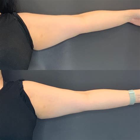 coolsculpting brisbane|Coolsculpting .